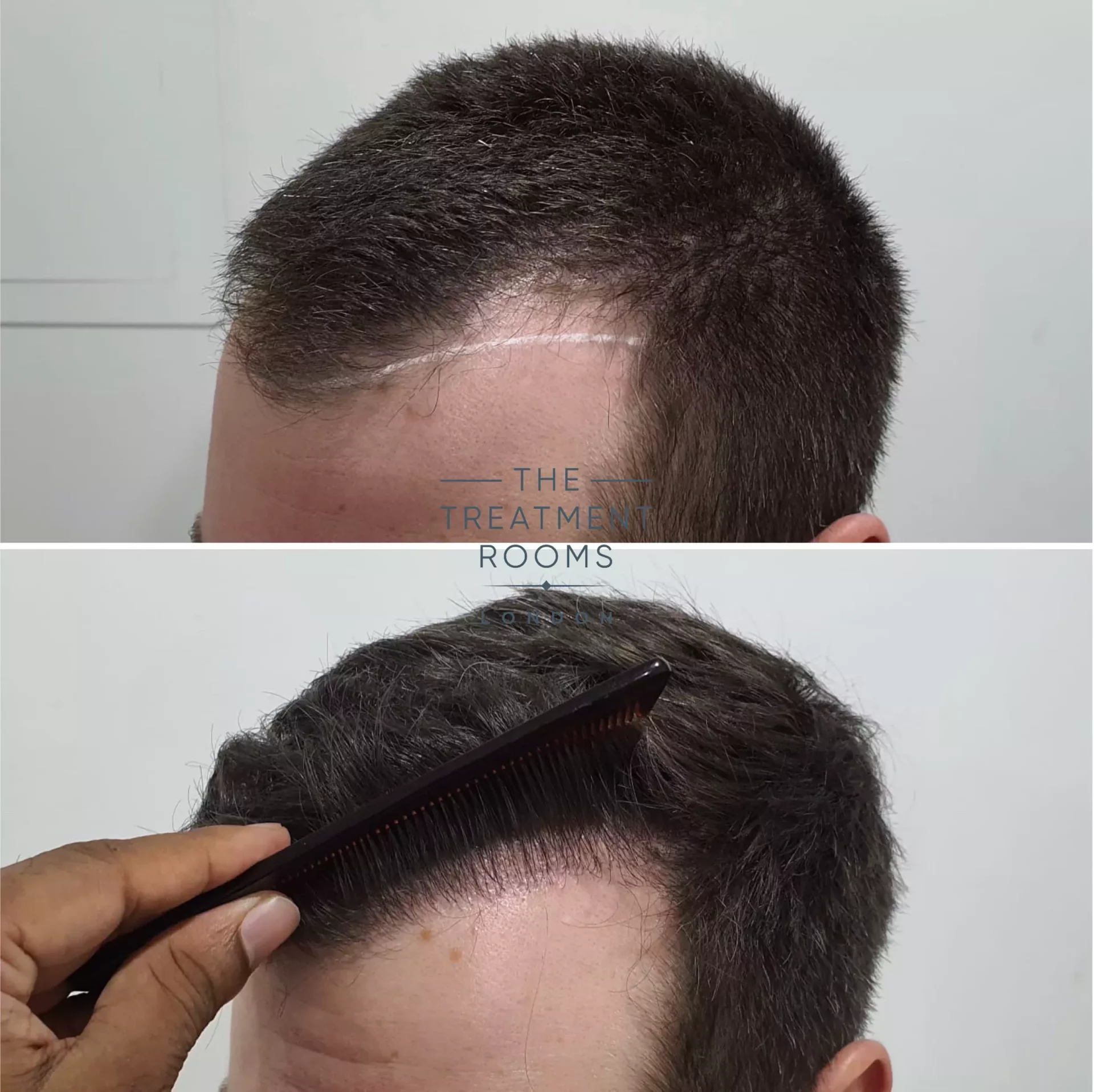 temple hair transplant 1297 grafts before and after