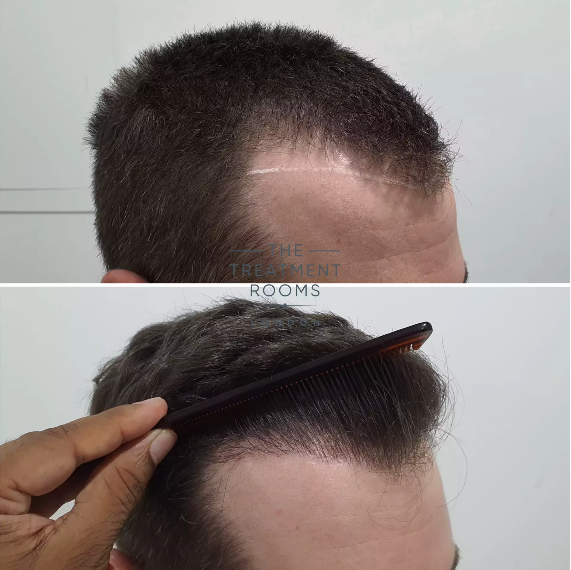 temple hair transplant 1297 grafts result