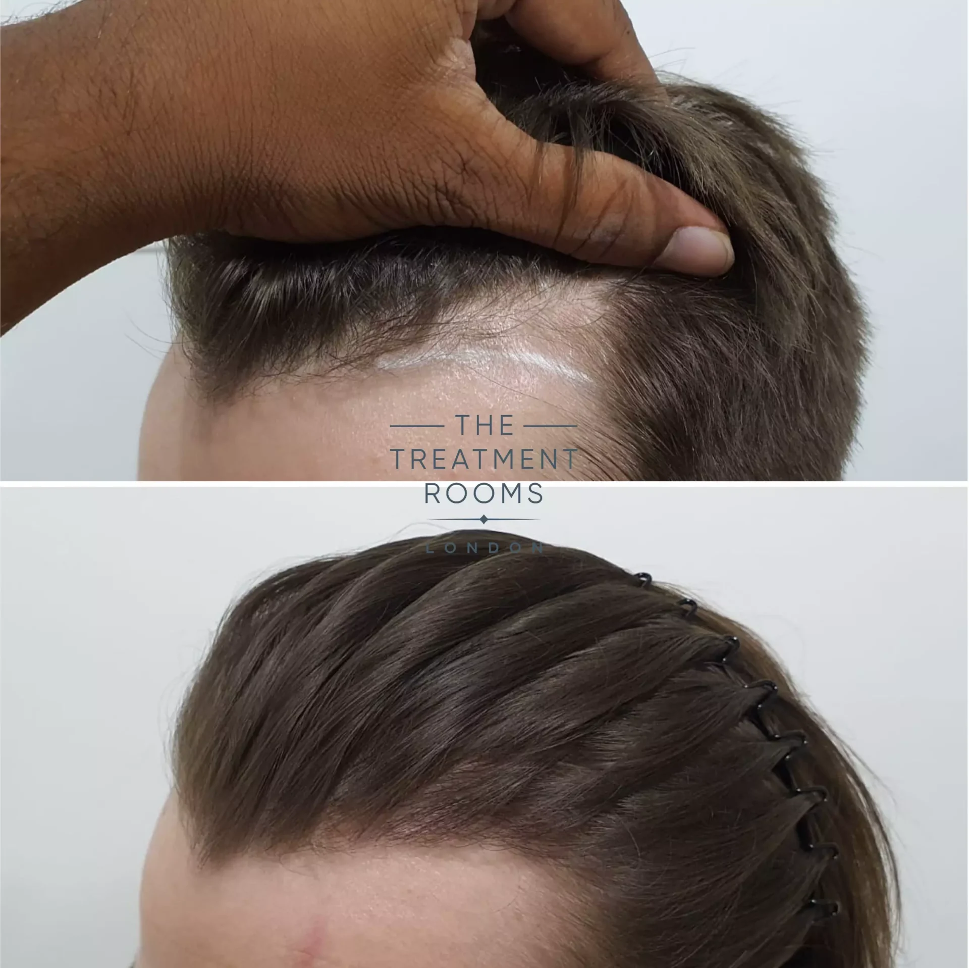 temple hair transplant 600 grafts before and after