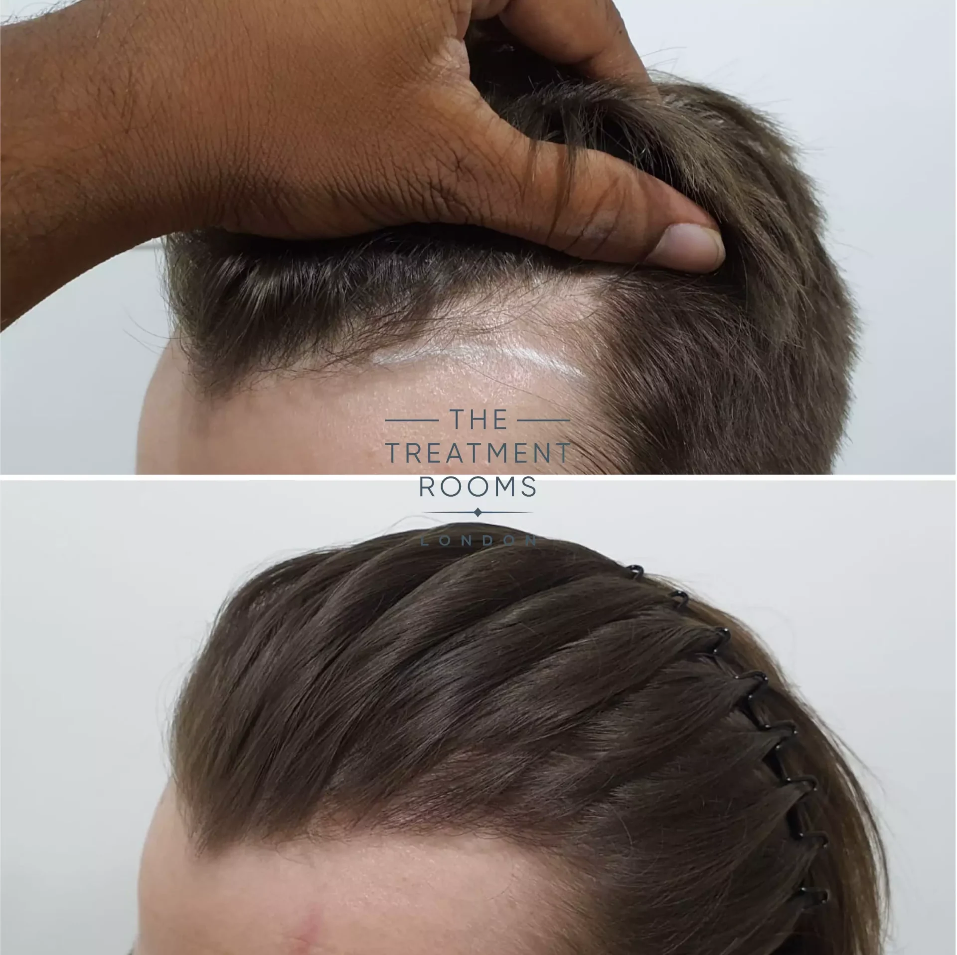 Temple shop hair loss