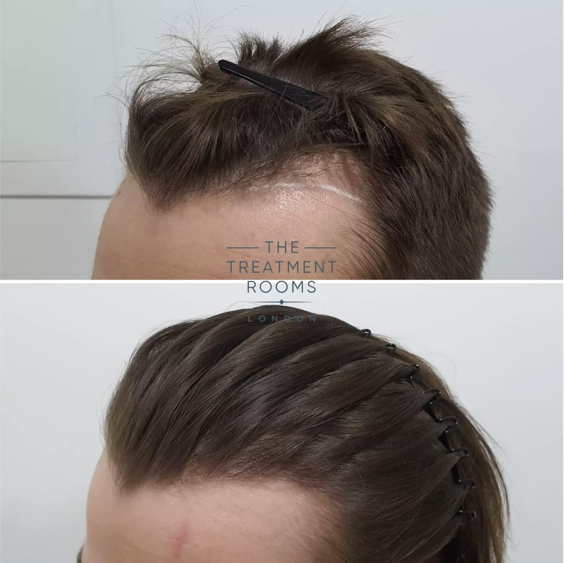 temple hair transplant 600 grafts result