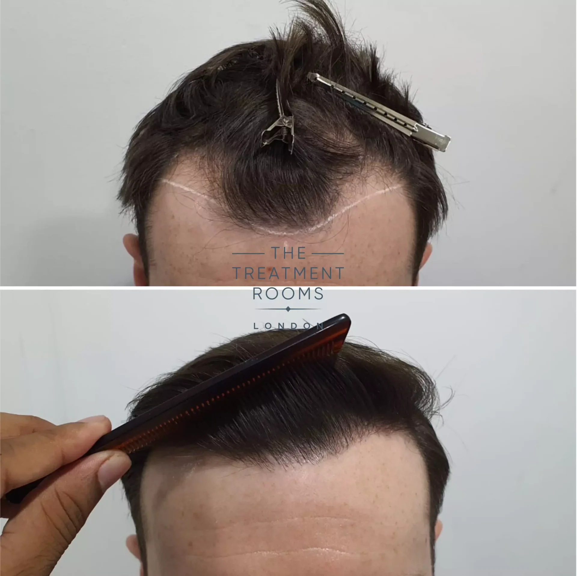temple hair transplant before and after 1014 grafts
