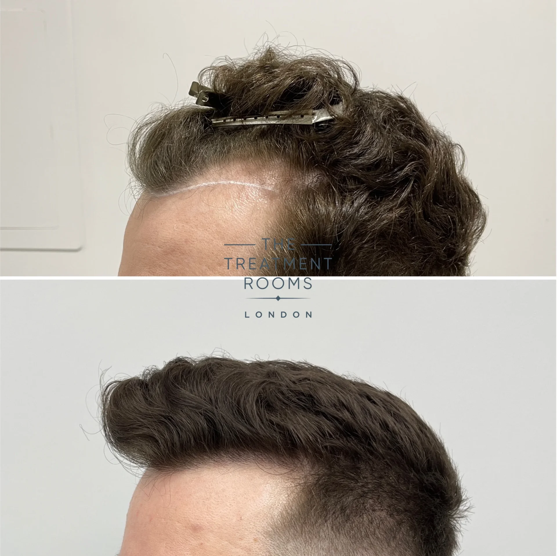 temple hair transplant london 1145 grafts before and after