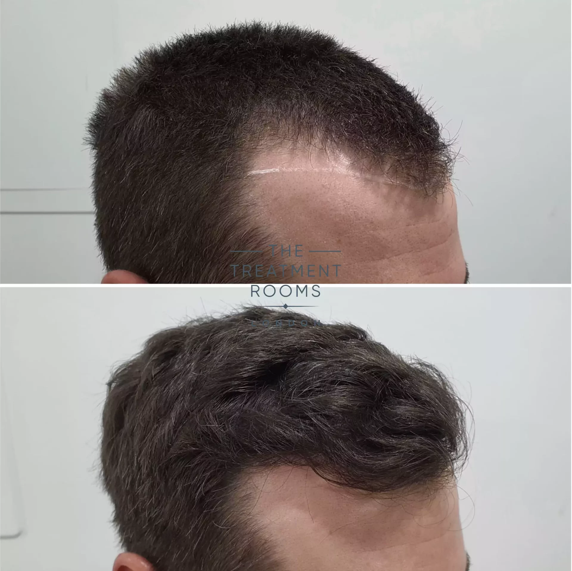 temple hair transplant london 1297 grafts before and after