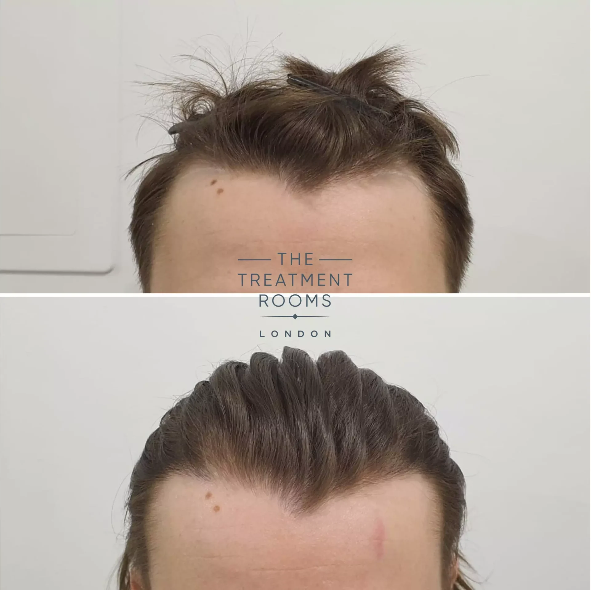 temple hair transplant london 600 grafts before and after