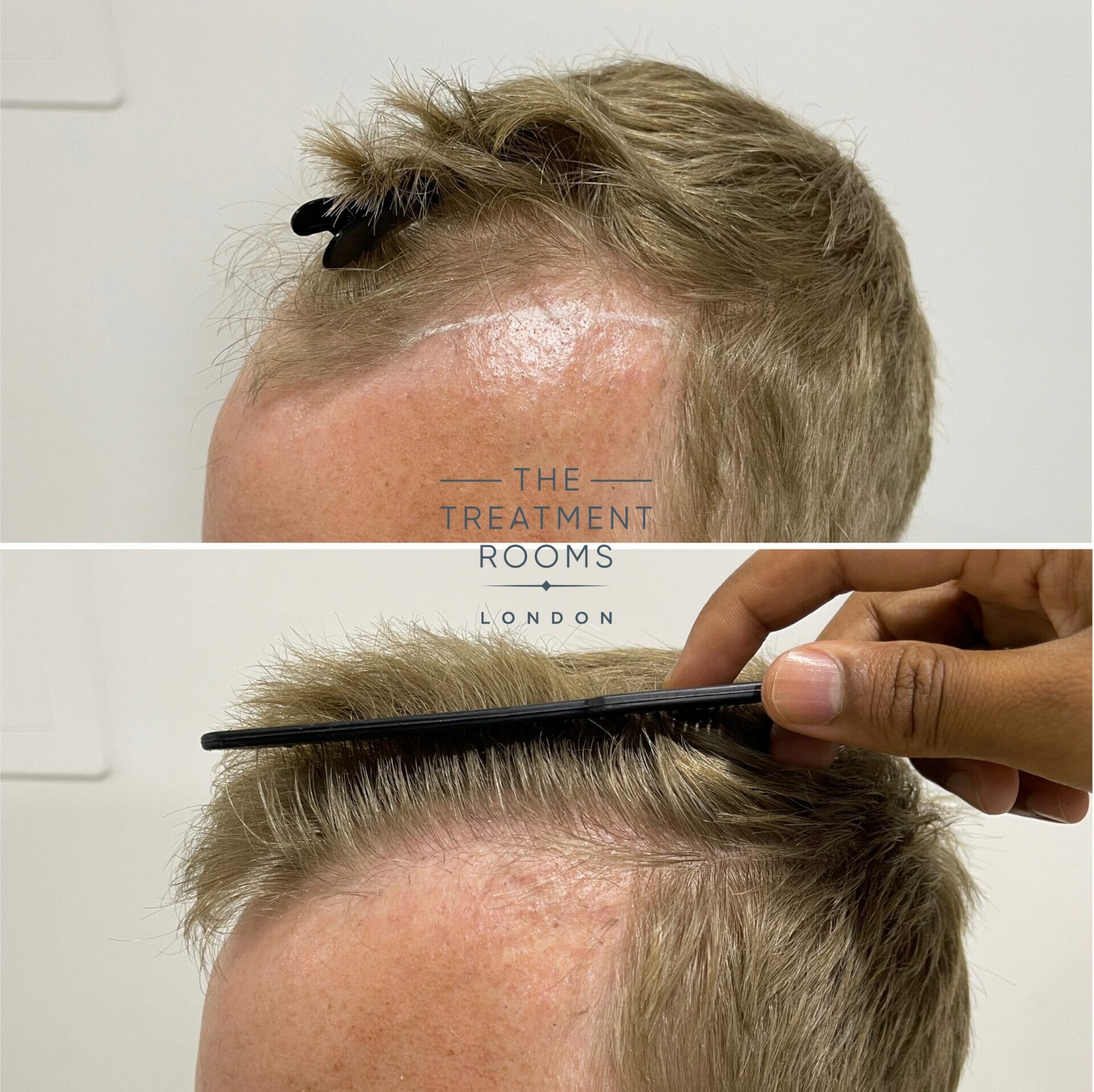 temple hair transplant repair 1020 grafts