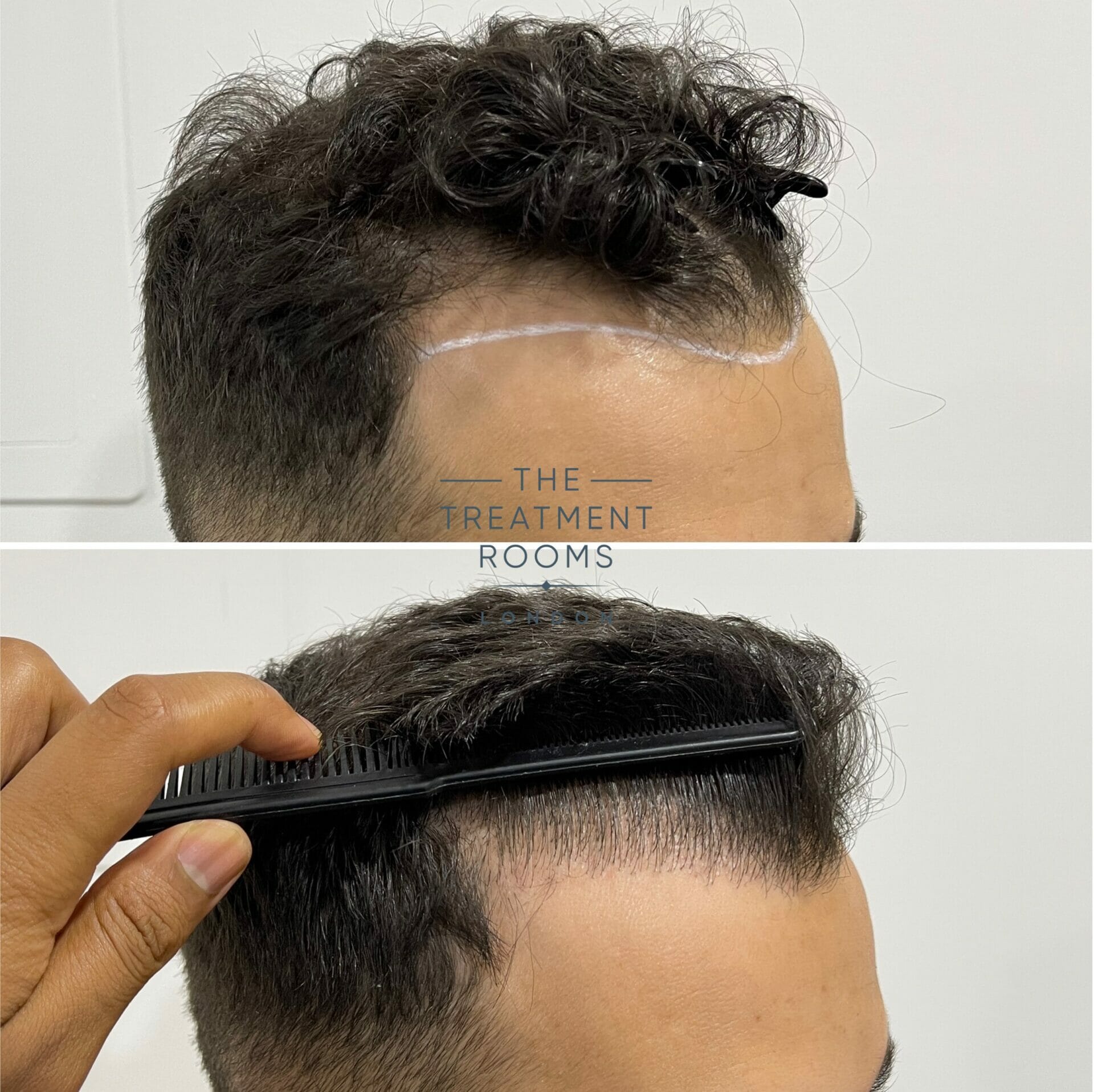 temple hairline hair transplant before and after 1552 grafts