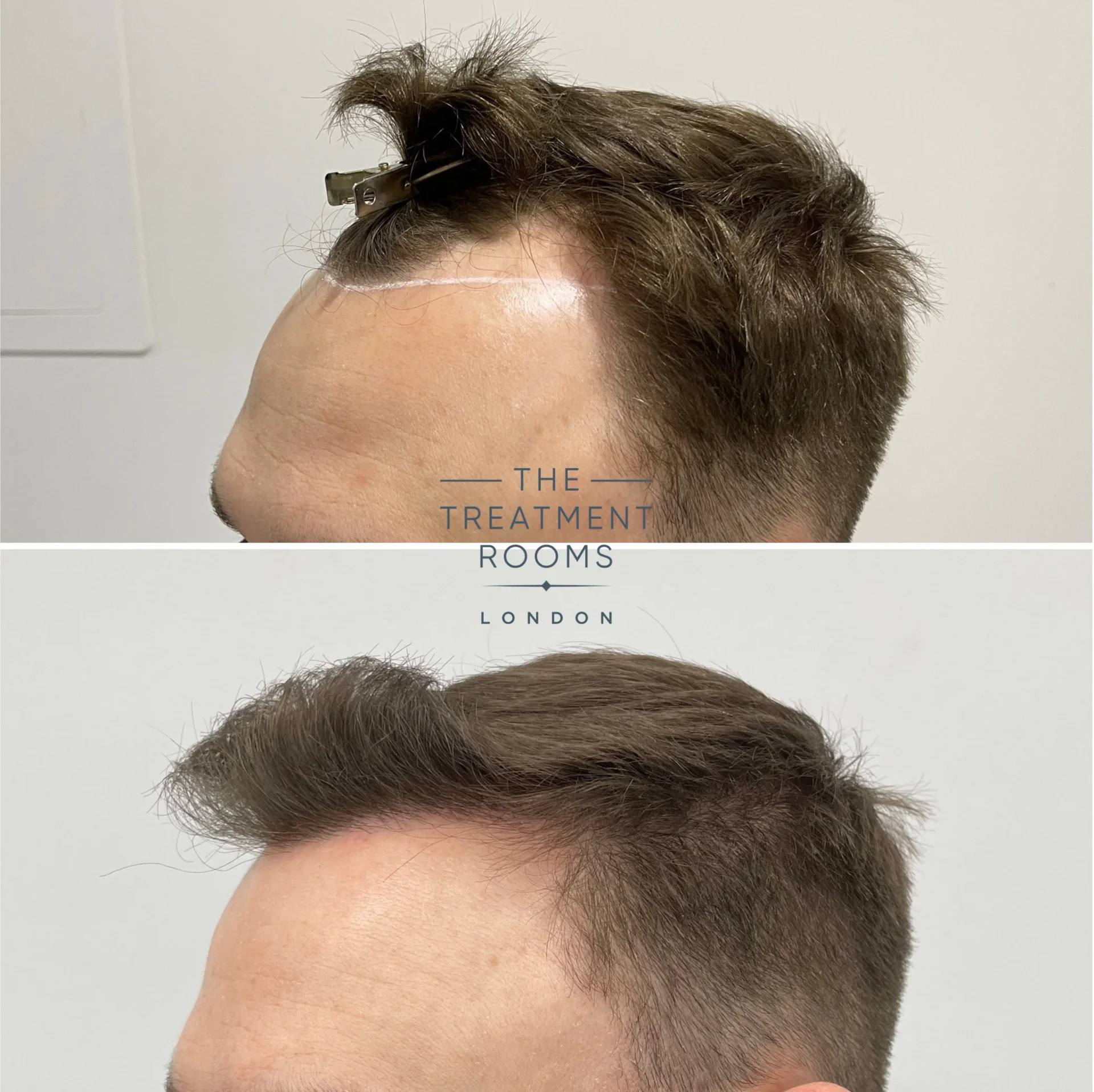 temples hair transplant london 1314 grafts before and after