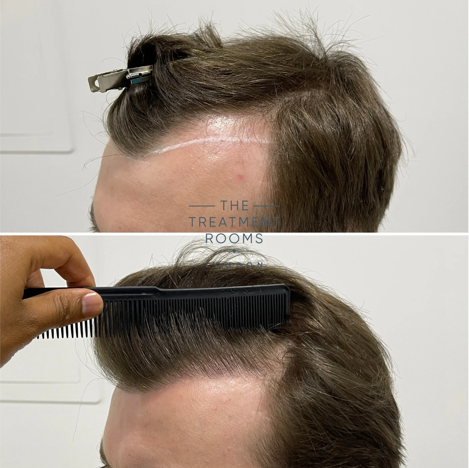 temples hair transplant surgery before and after