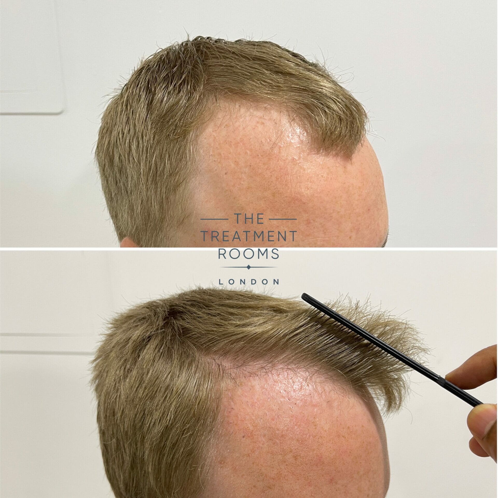 temples repair hair transplant before and after