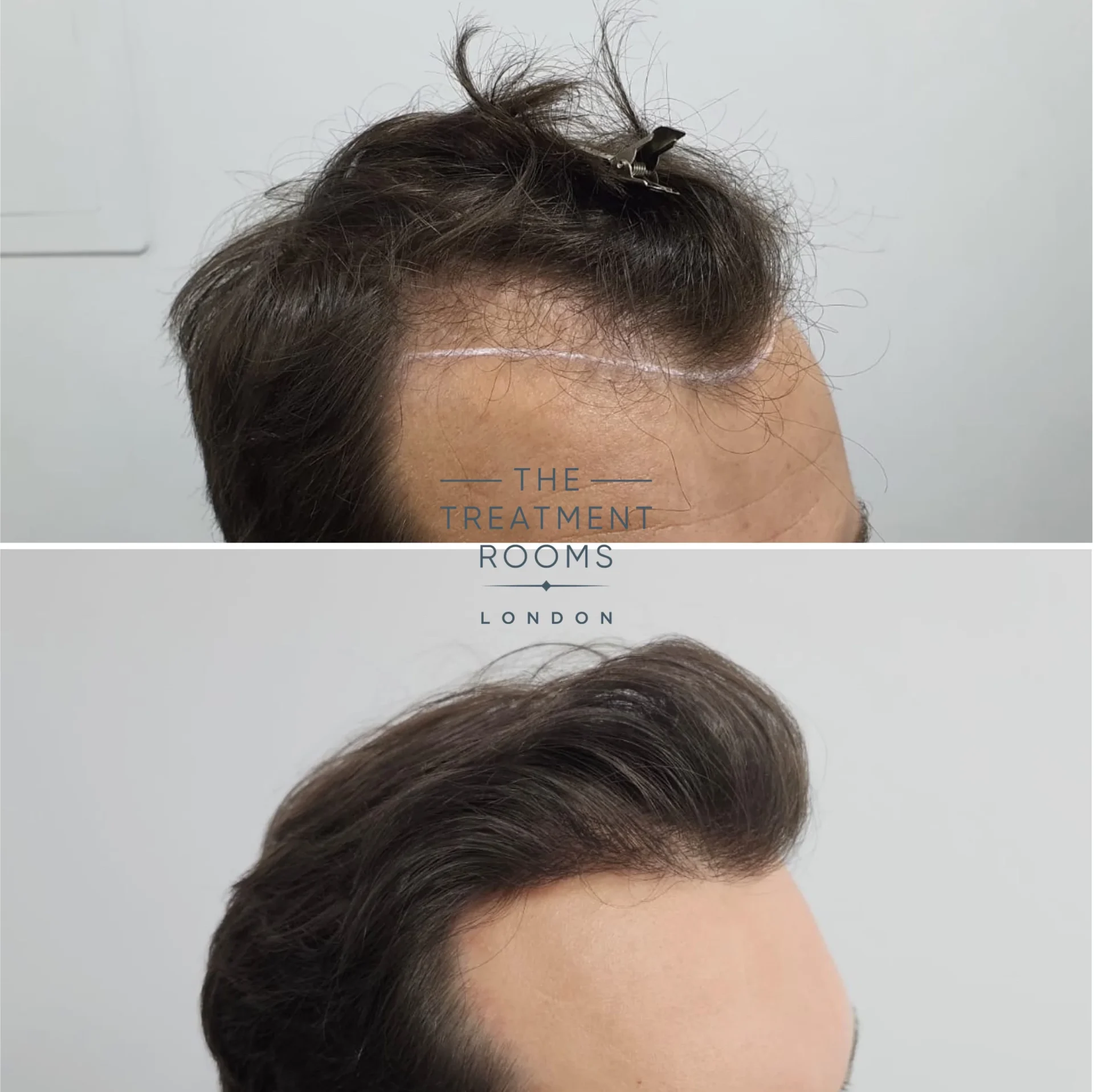 thin hair fue transplant 1385 grafts before and after
