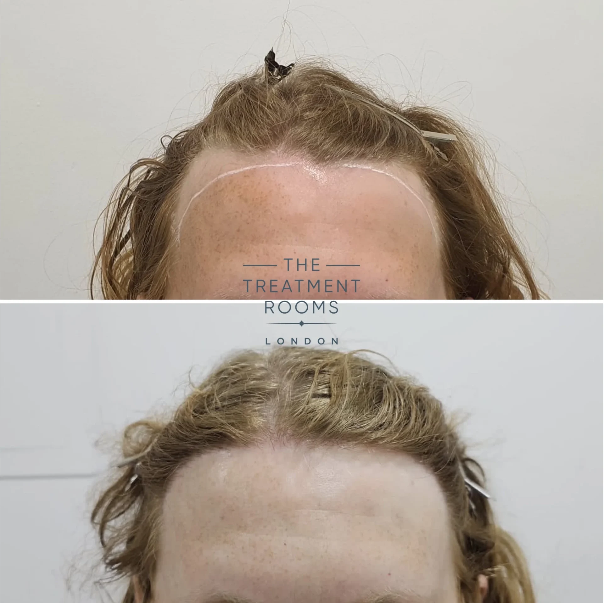 transgender fue hair transplant 1994 grafts before and after