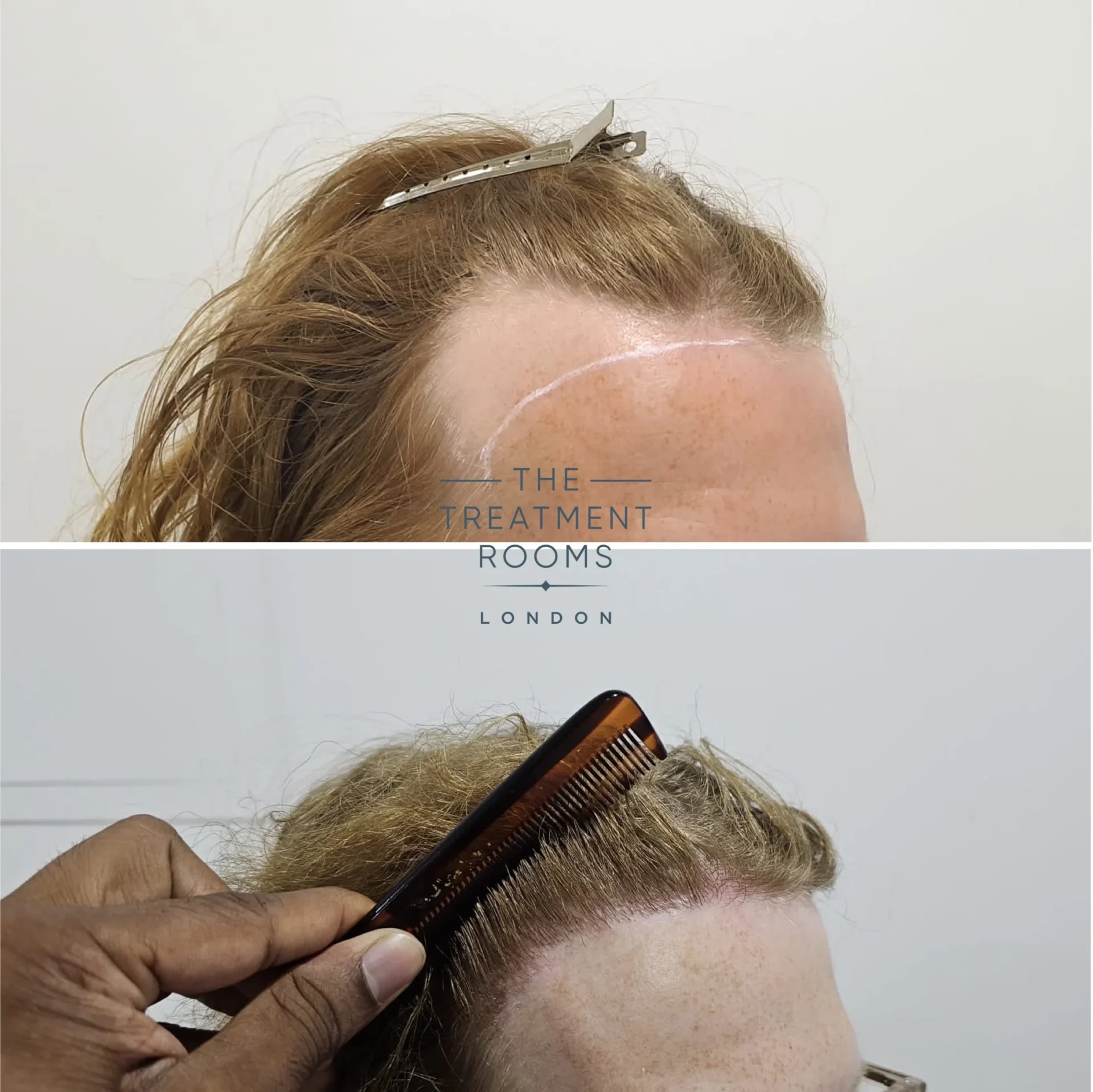 transgender fue hair transplant clinic 1994 grafts before and after