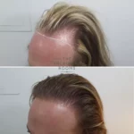 transgender fue hair transplant result