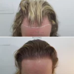 transgender hair transplant 1509 grafts before and after