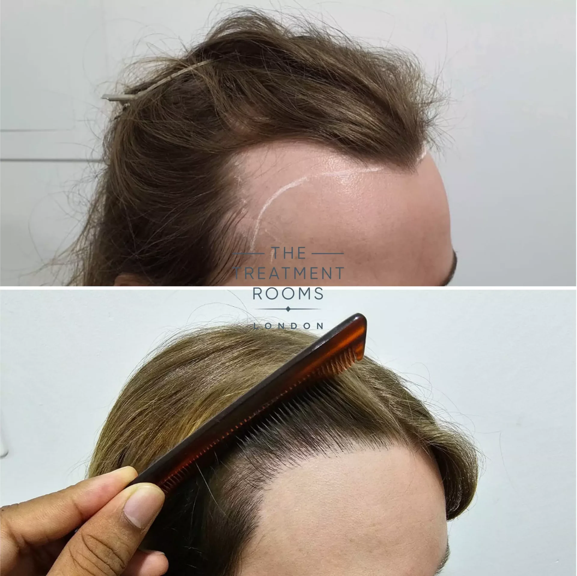 transgender hair transplant 1553 grafts before and after