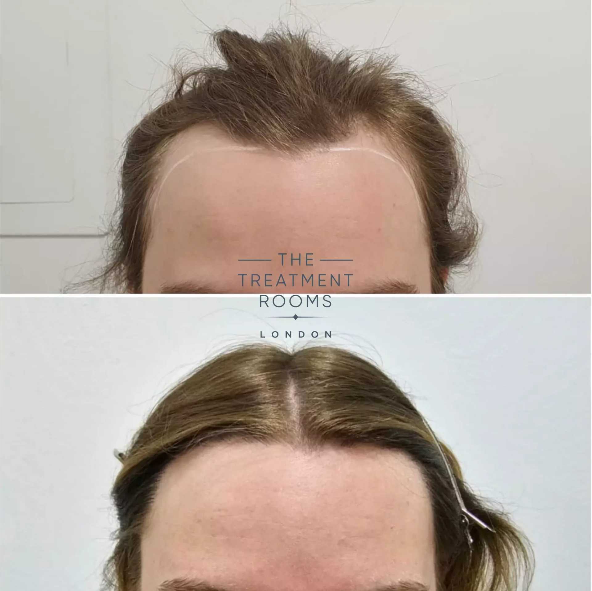 transgender hair transplant 1553 grafts