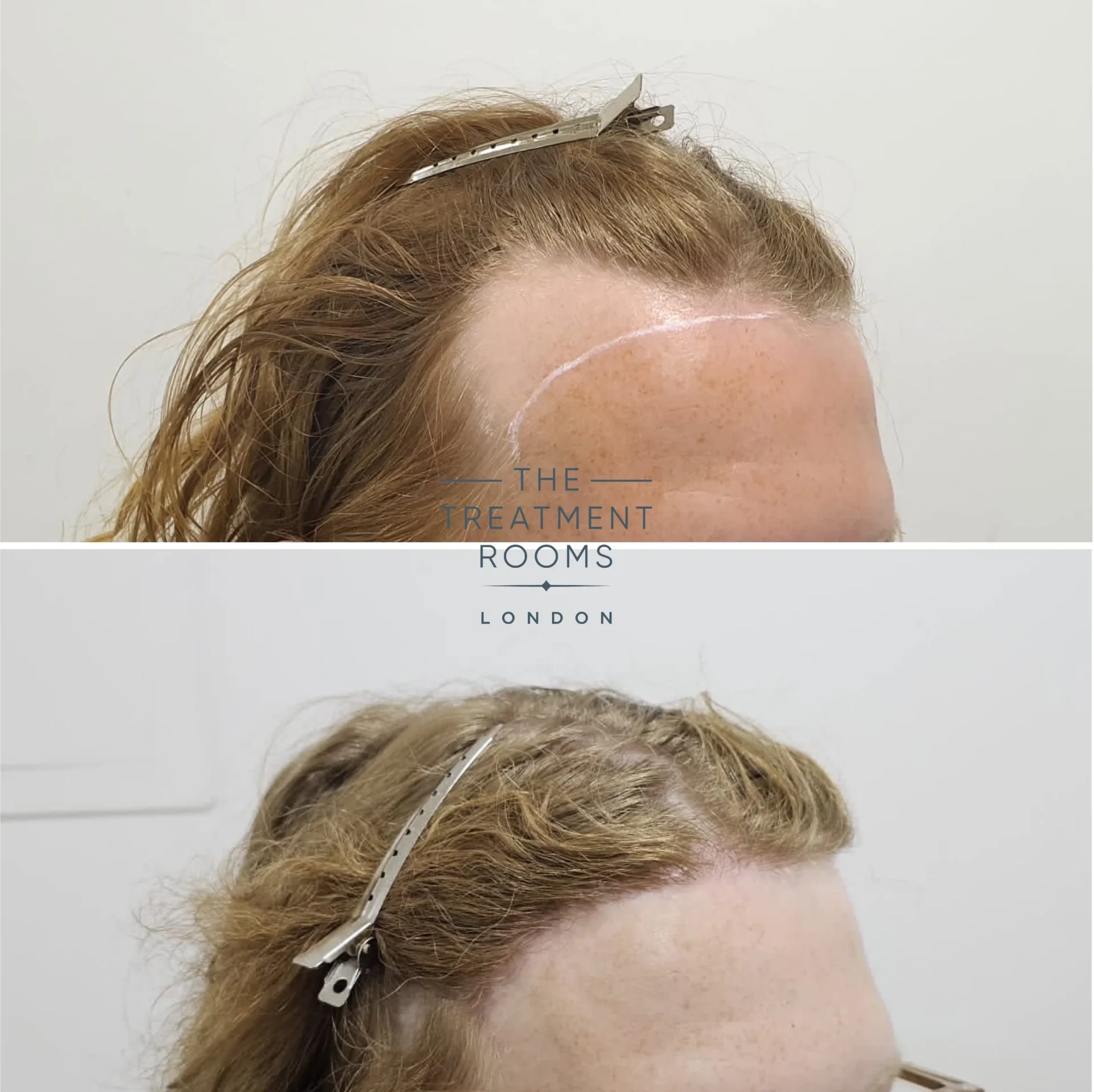 transgender hair transplant 1994 grafts before and after