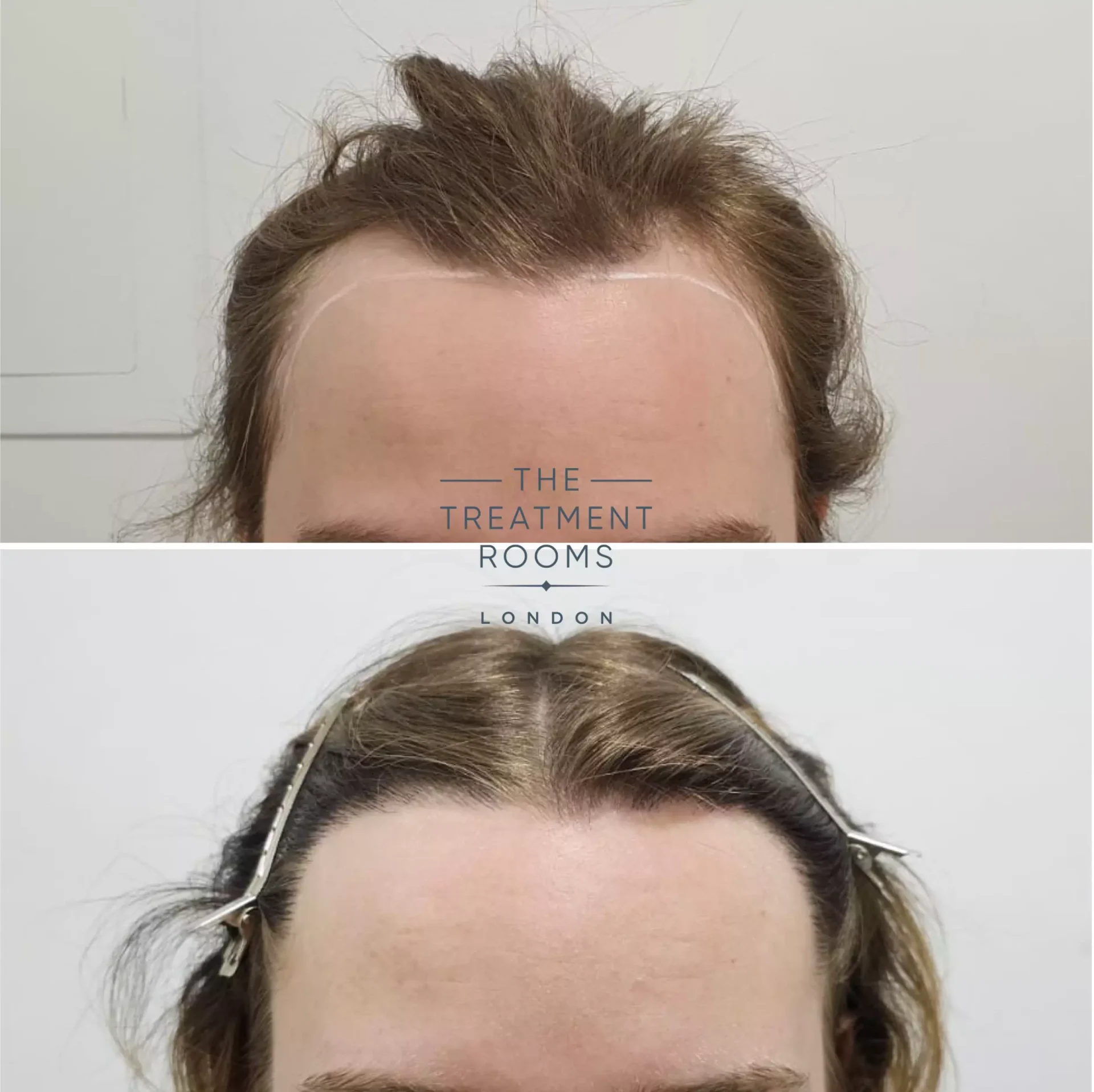 transgender hair transplant clinic 1553 grafts before and after