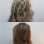 transgender hair transplant clinic donor area before and after