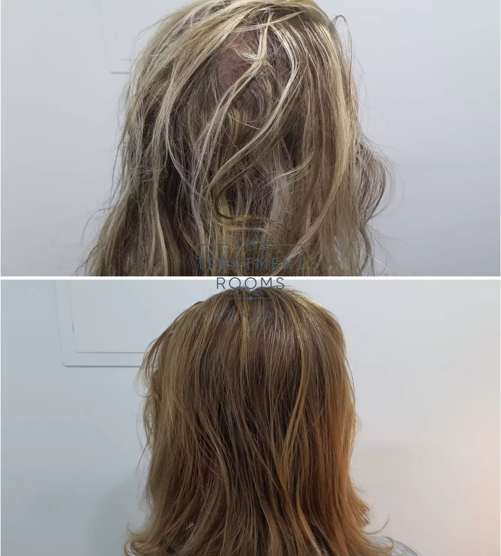 transgender hair transplant clinic donor area before and after
