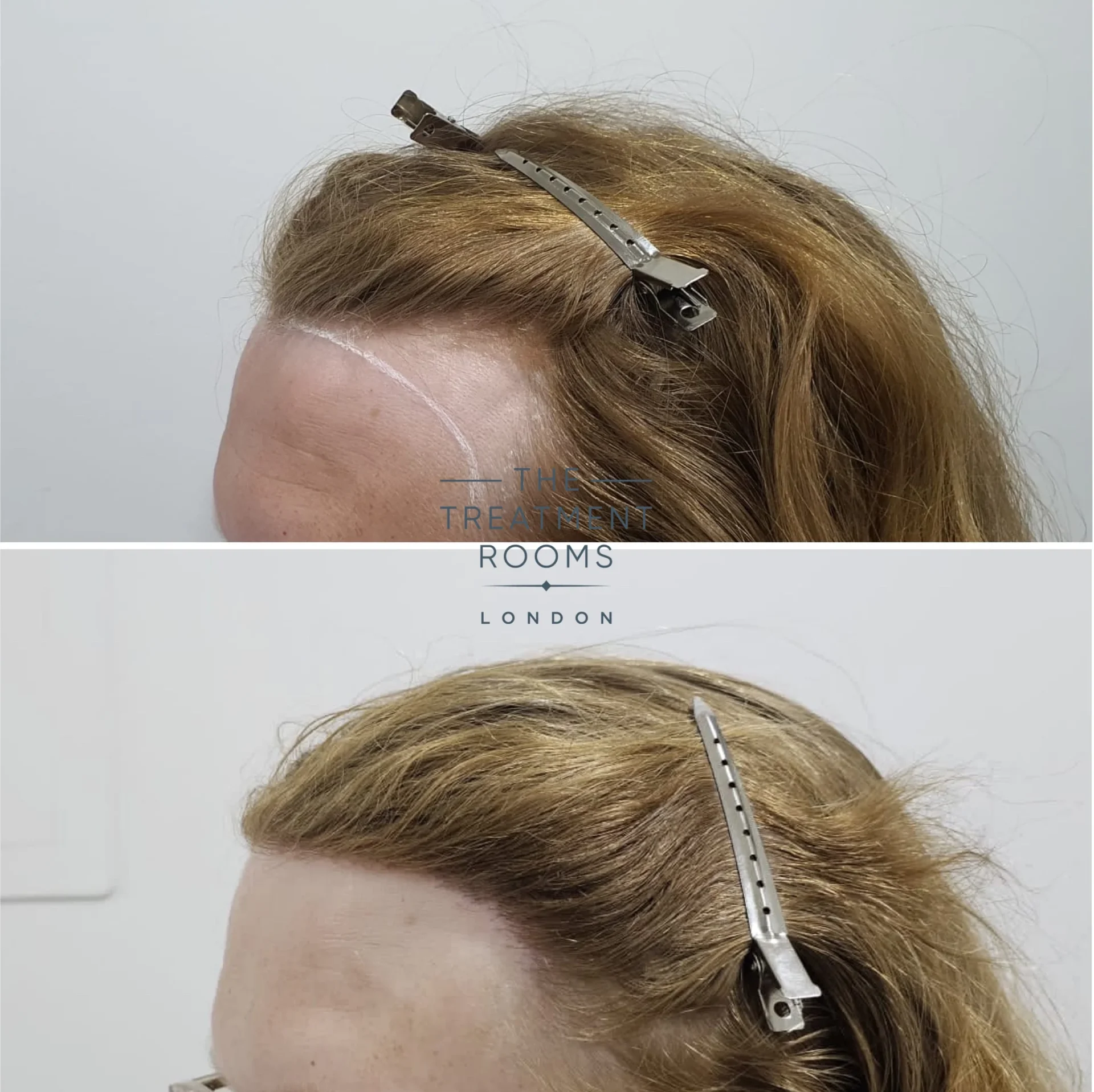 transgender hair transplant clinic london 1994 grafts before and after