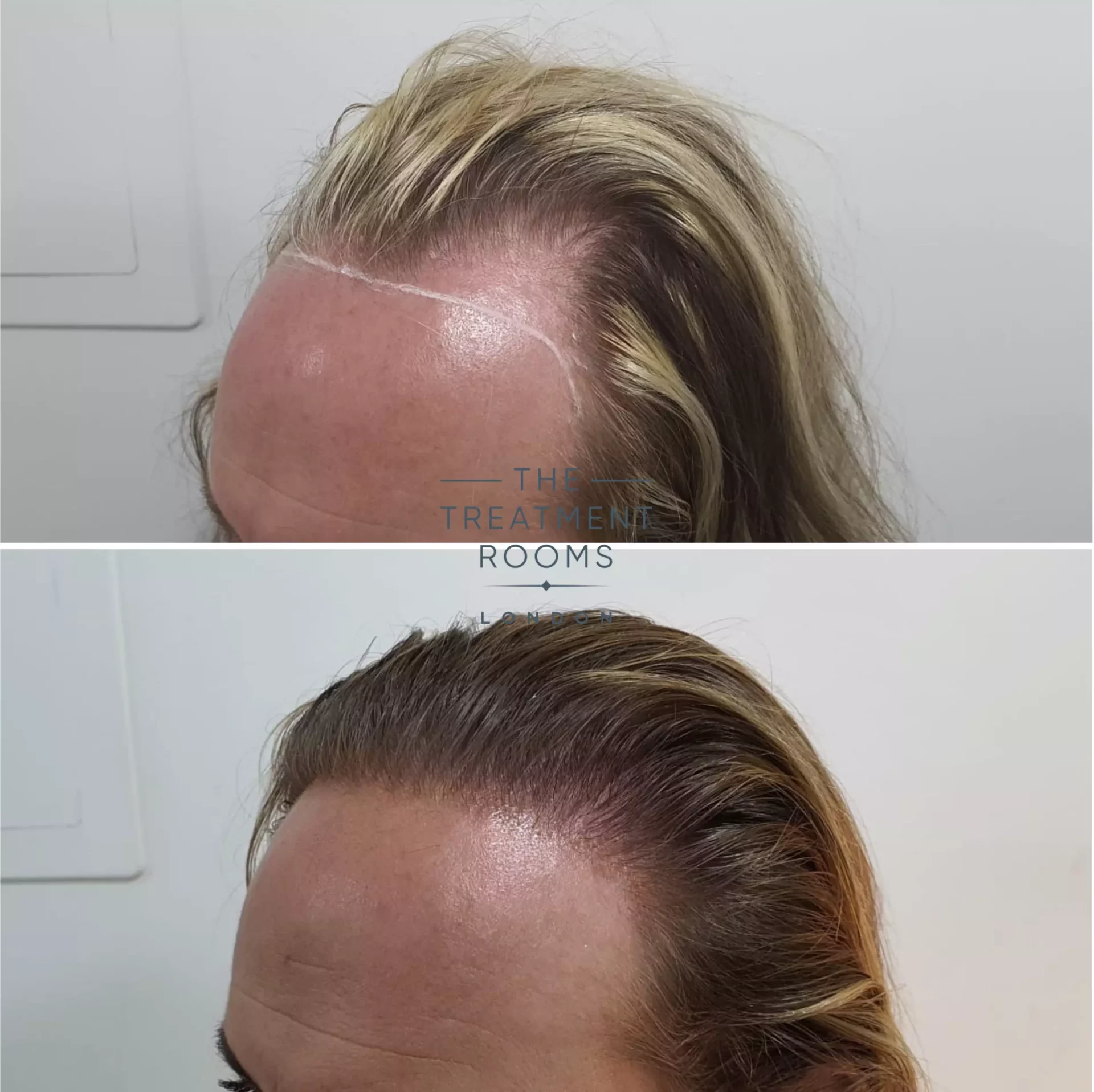 transgender hair transplant clinic result 1509 grafts