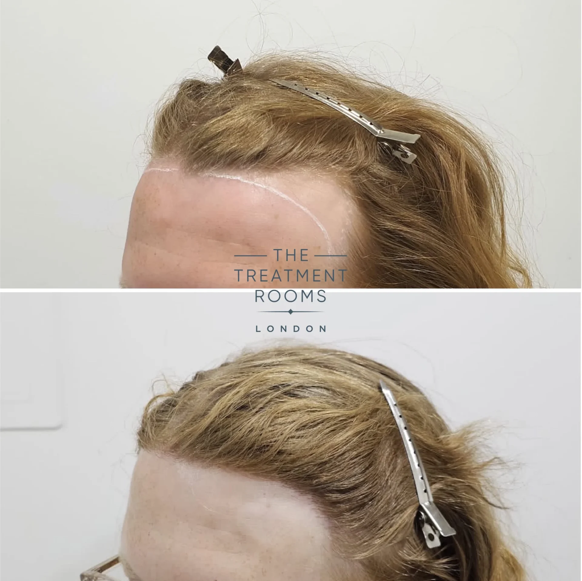 transgender hair transplant london 1994 grafts before and after