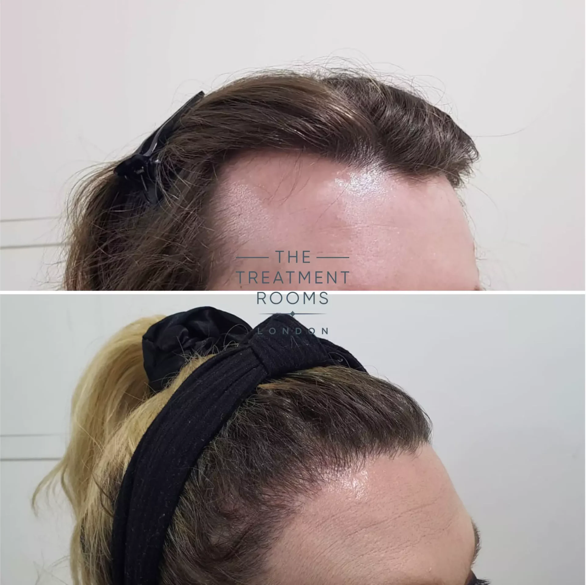 transgender hair transplant london 2319 grafts result