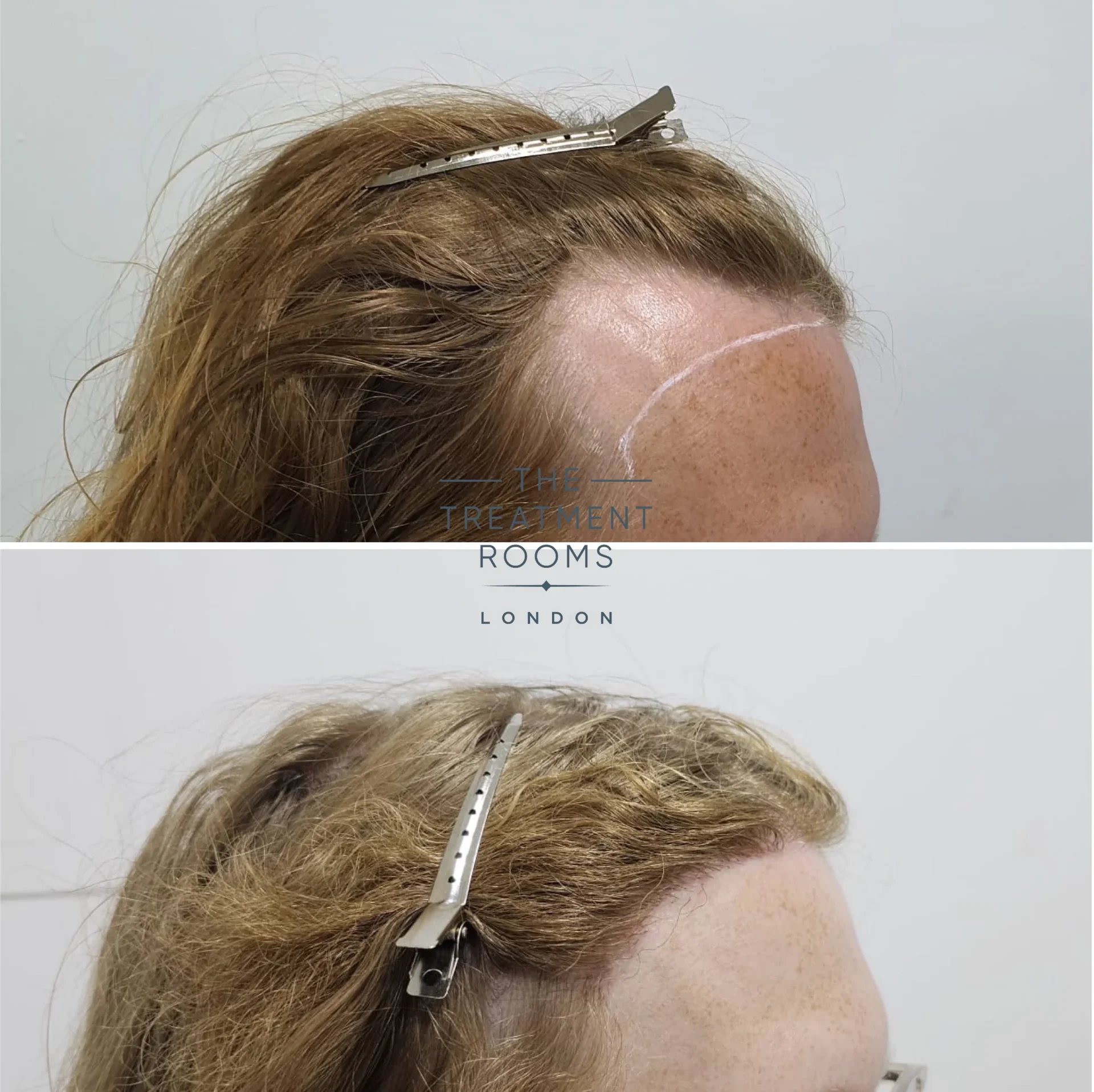 transgender hairline fue transplant london 1994 grafts before and after
