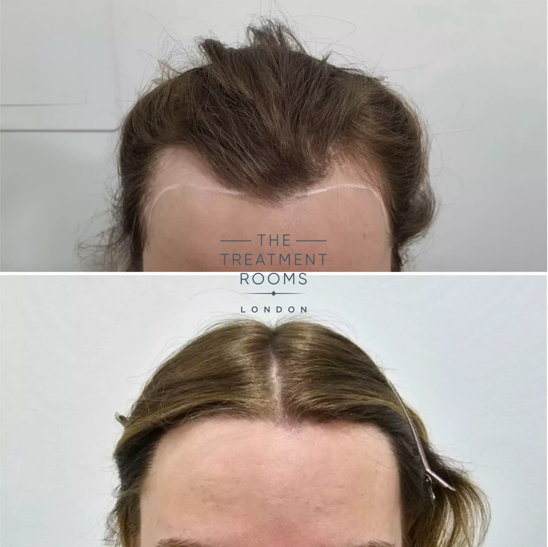 transgender hairline transplant 1553 grafts before and after