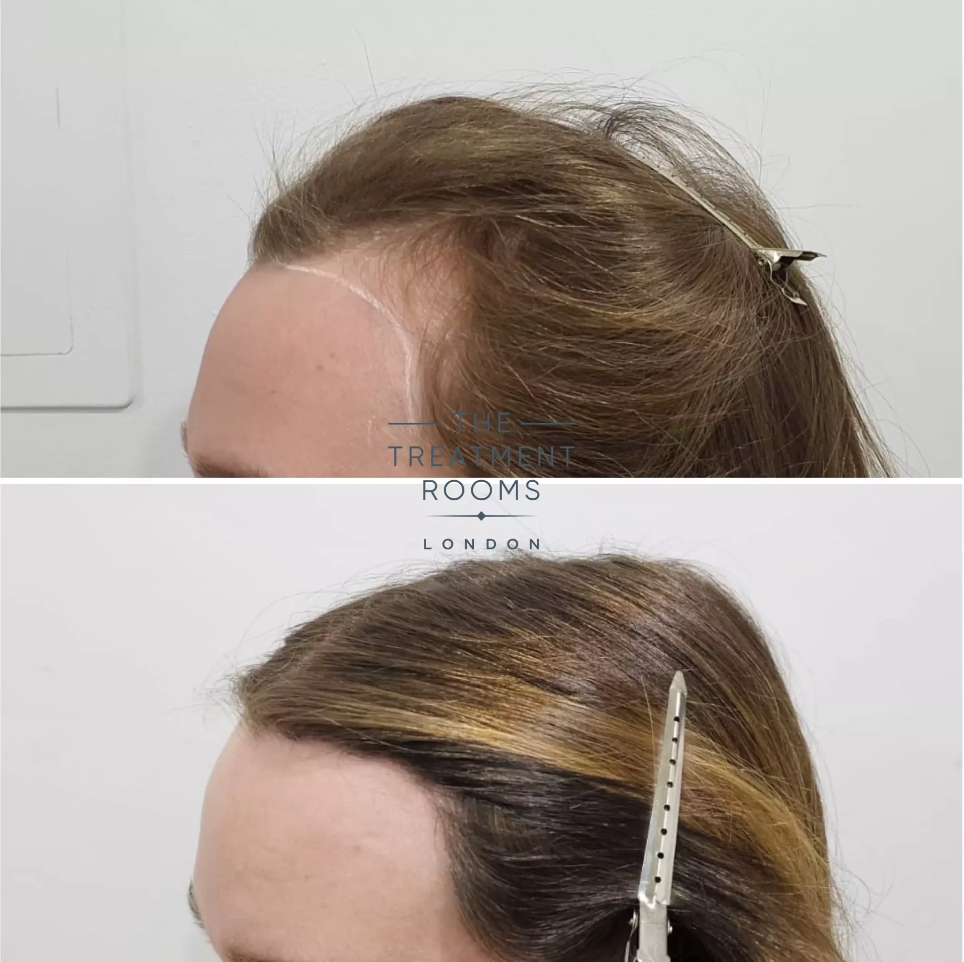 transgender hairline transplant london 1553 grafts before and after