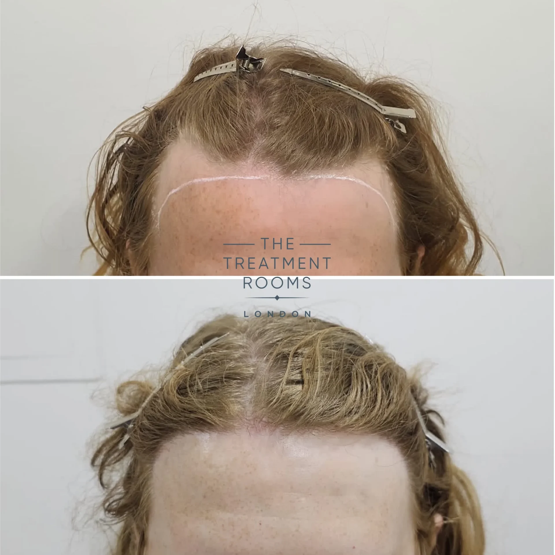 transgender hairline transplant london 1994 grafts before and after