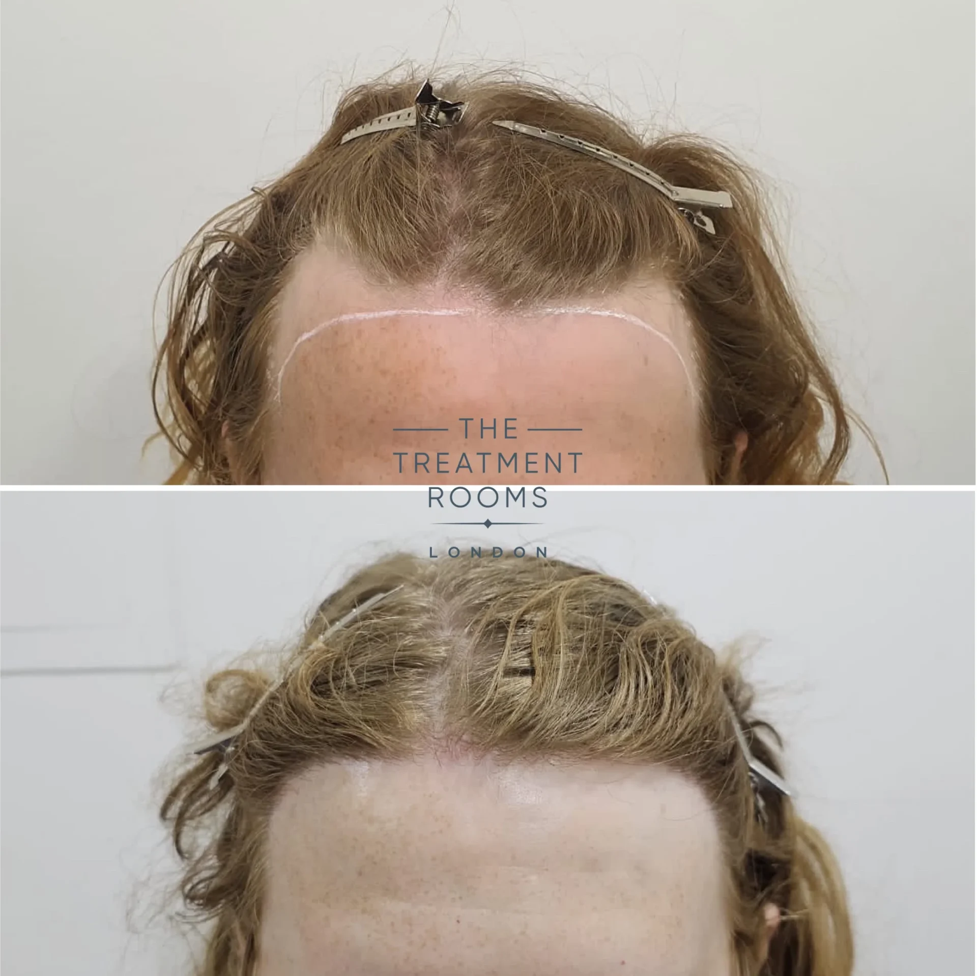 transgender hairline transplant london 1994 grafts before and after transgender hairline transplant london 1994 grafts before and after