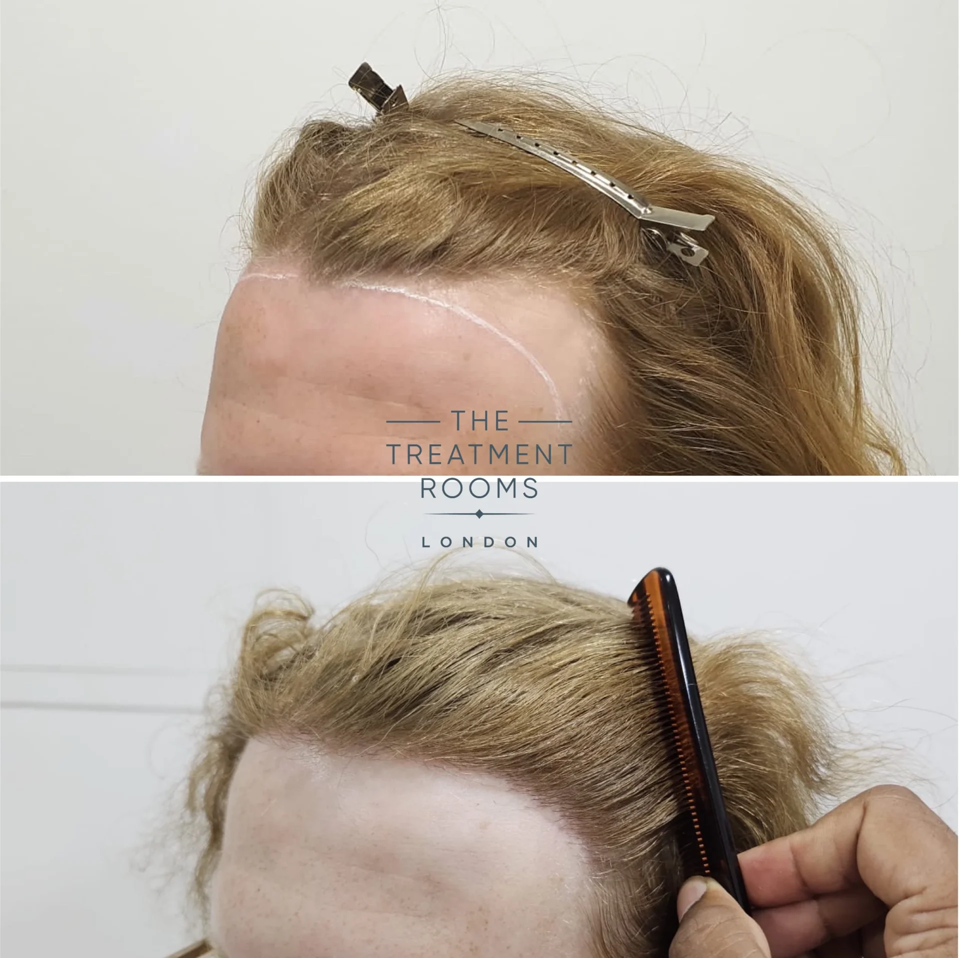 transgender hairline transplant unshaven london 1994 grafts before and after