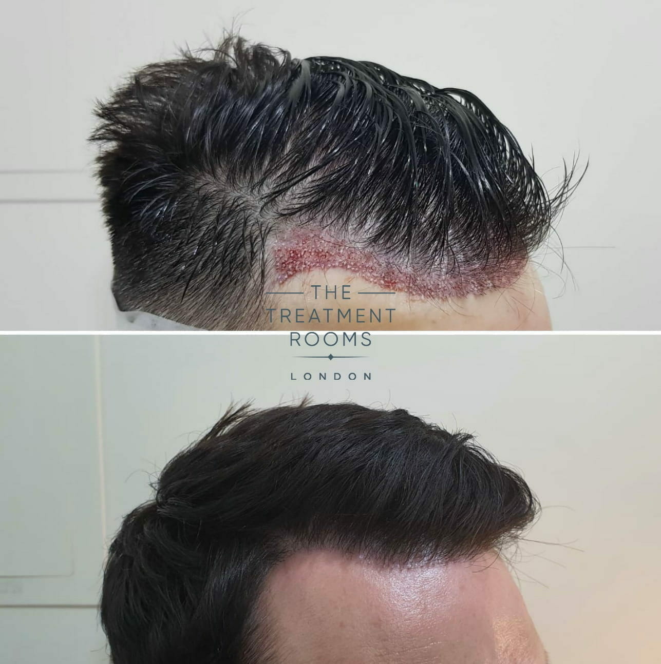 unshaven FUE hair transplant