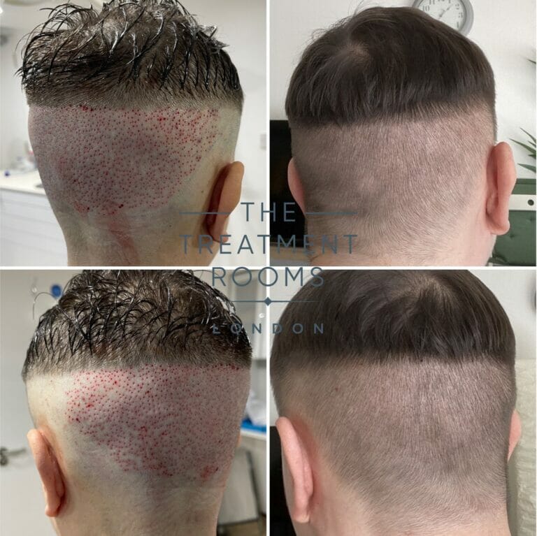 Unshaven FUE Hair Transplant (UFUE) The Treatment Rooms London