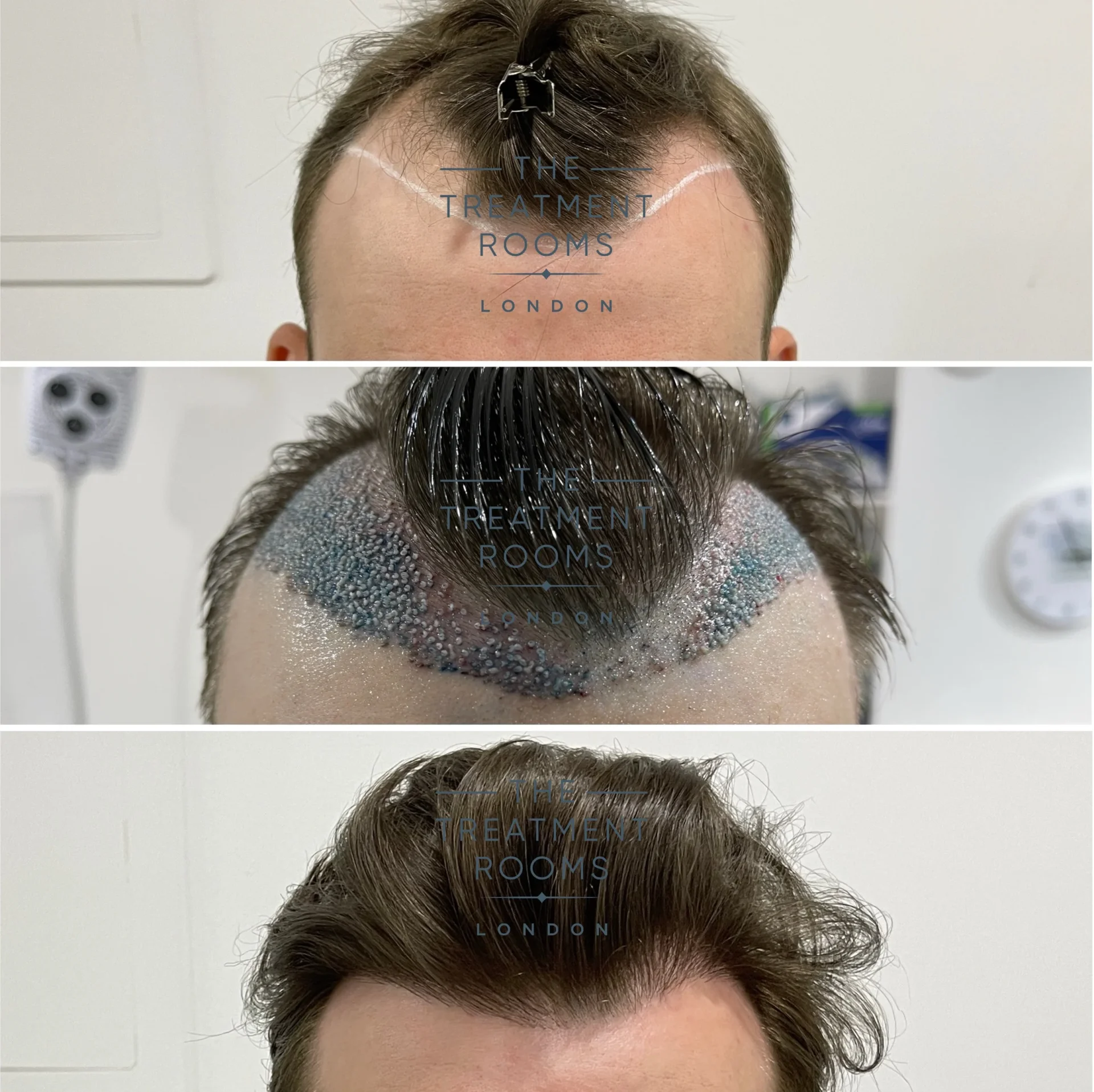 unshaven hair transplant for hairline