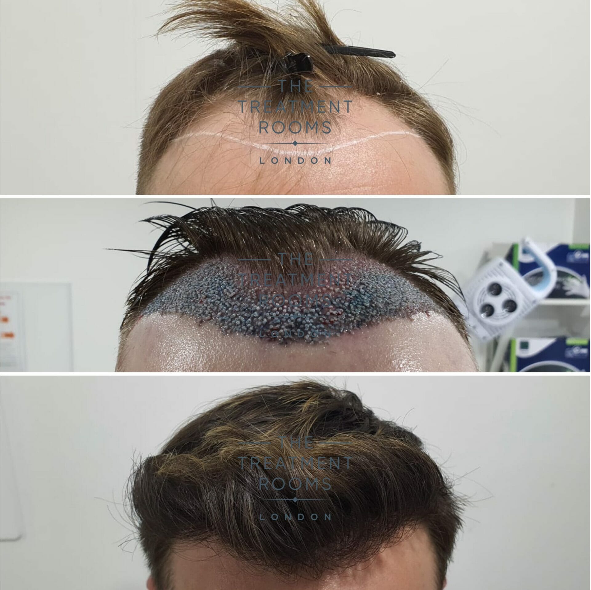 Male Hair Transplant Before and After | Melbourne