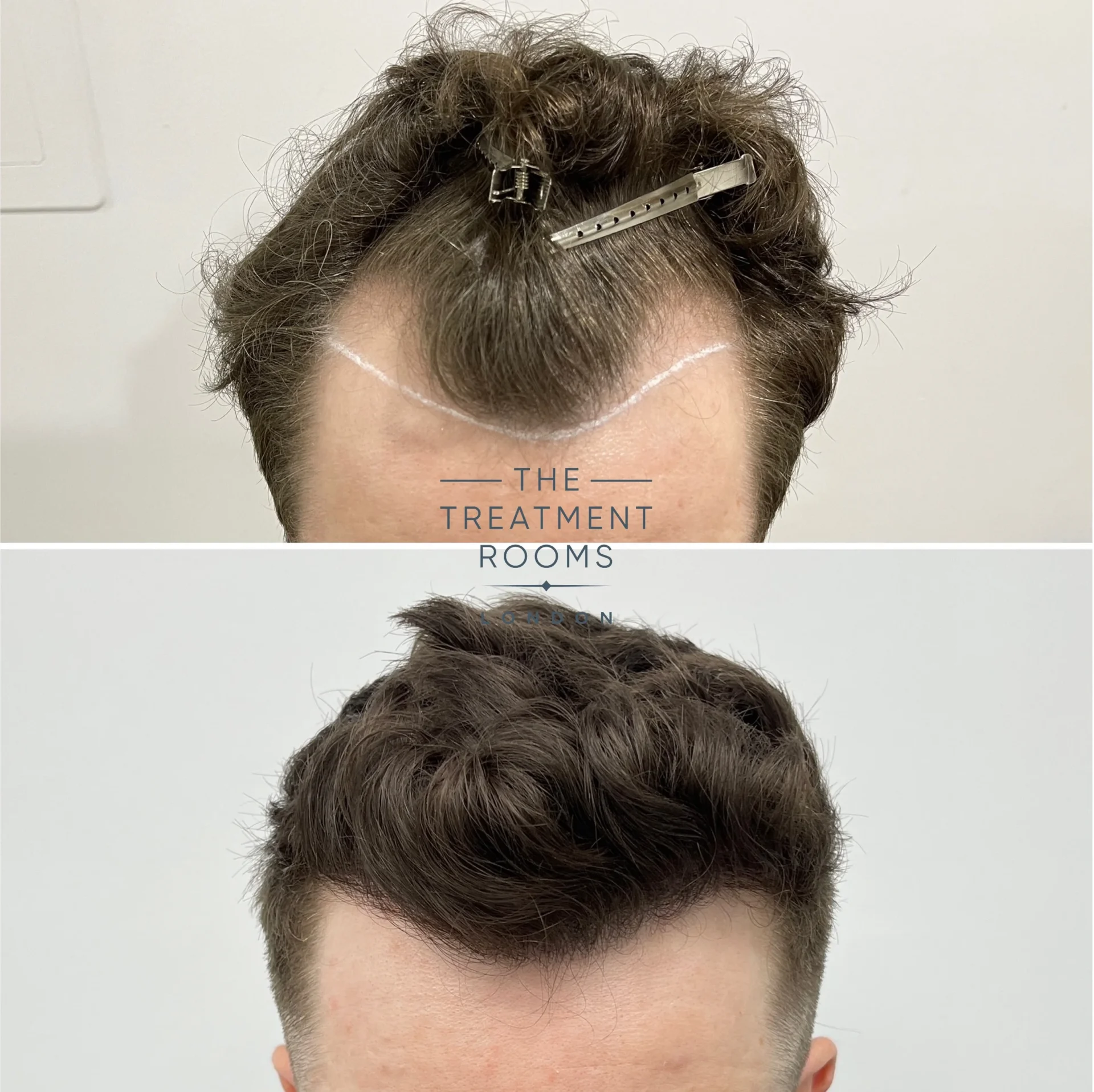 widow's peak and temple recession hair transplant before and after