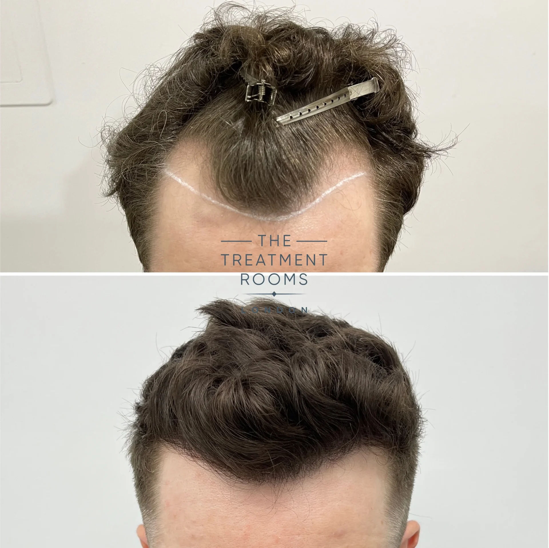 Fixing a Widow's Peak with a Hair Transplant | Treatment Rooms London