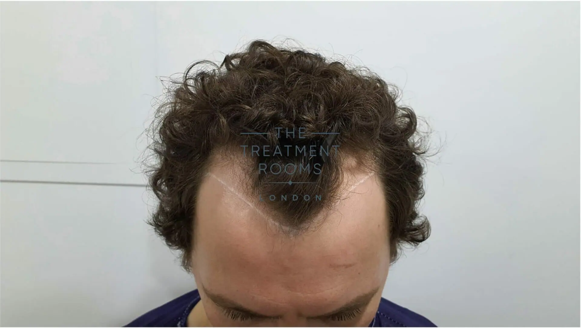 widow's peak example