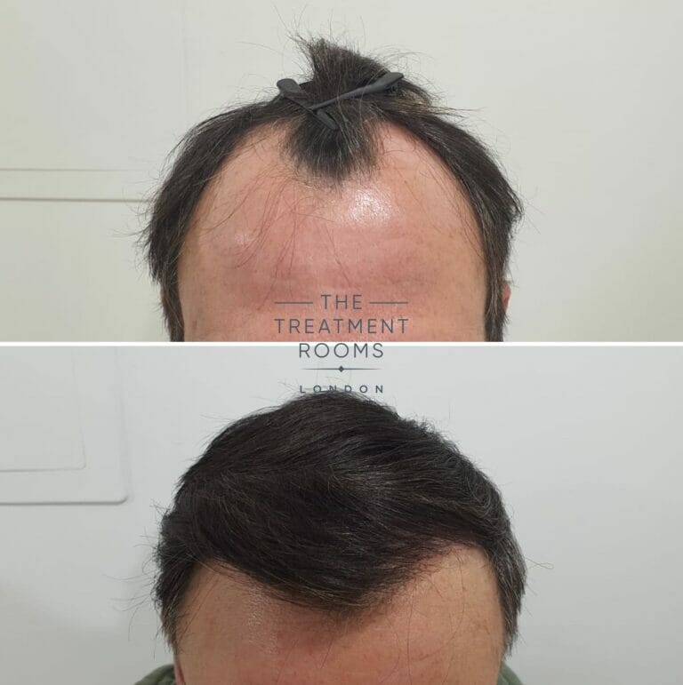 Fixing a Widow's Peak with a Hair Transplant Treatment Rooms London