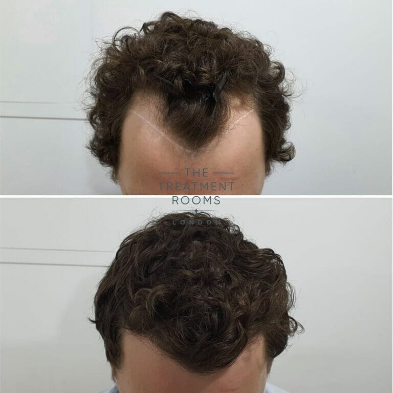 What Is A Widow's Peak? | The Treatment Rooms London