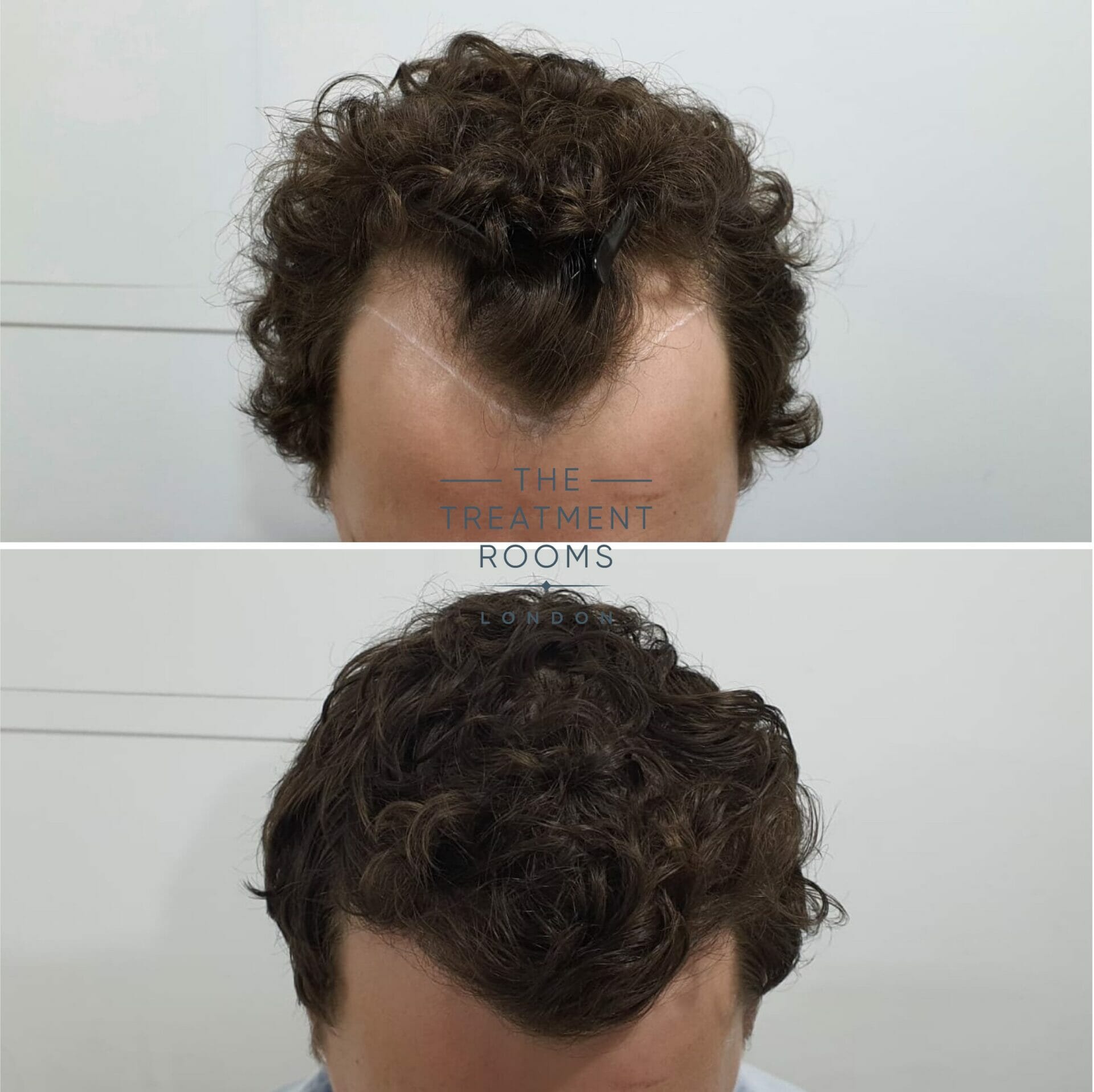 widow's peak hair transplant cost